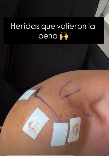 Gary Centeno mostró como le quedó el hombro después de su operación.