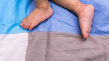 Alerta de sarampión a nivel internacional pone en riesgo a menores en el país