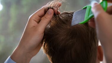 Murió niño por severa infección causada por piojos: caso genera alarma