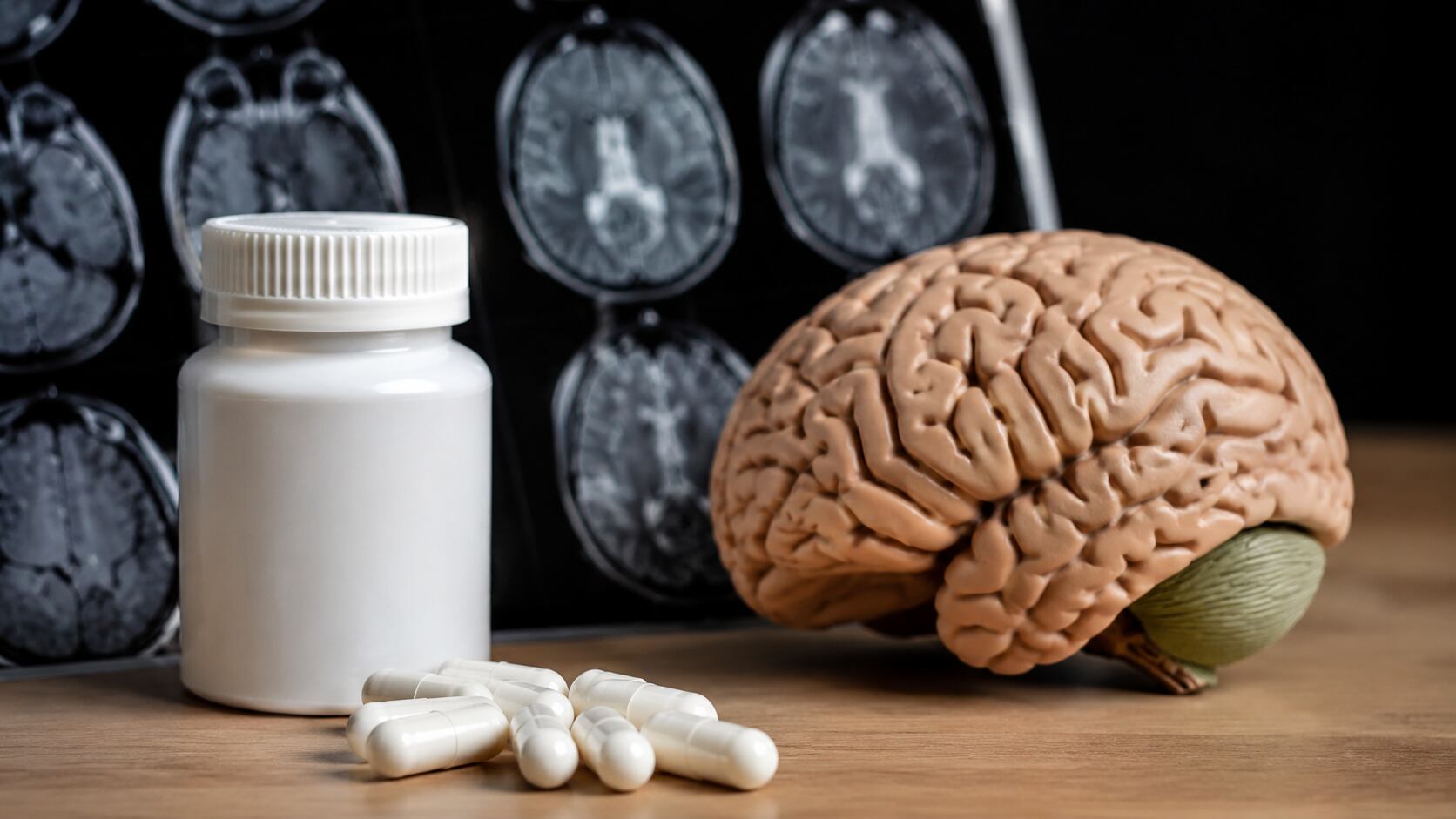 Un estudio relacionó la glucosamina con una progresión más rápida del Alzheimer y una menor supervivencia en pacientes con demencia.