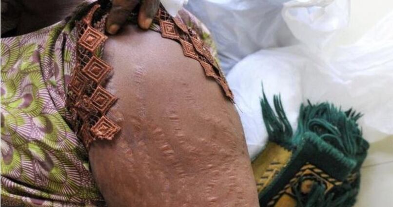 Inyecciones para blanquear la piel