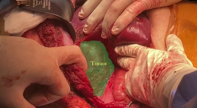 Especialistas del Hospital San Juan de Dios le quitaron un tumor bien grande a un joven, el cual se encontraba ubicado en el lado derecho del tórax y ponía en peligro órganos vitales como corazón, riñón, hígado y la vena cava inferior