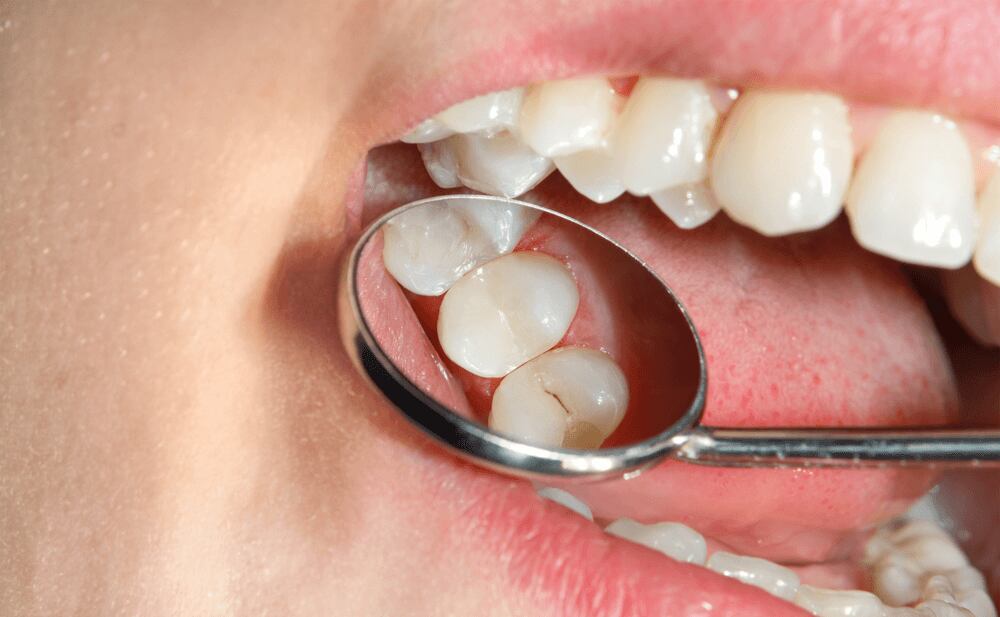 Caries pueden provocar graves problemas
