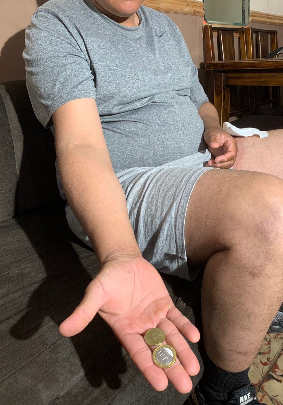 Monedas desviaban bala que iba a impactar pierna izquierda de repartidor de comida. Foto Keyna Calderón.