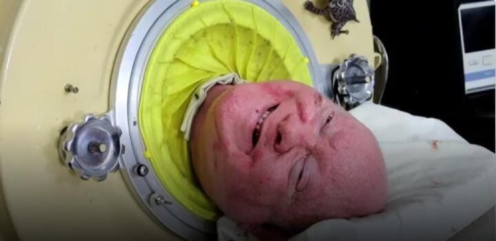 Pulmón de Acero
polio
Paul Alexander