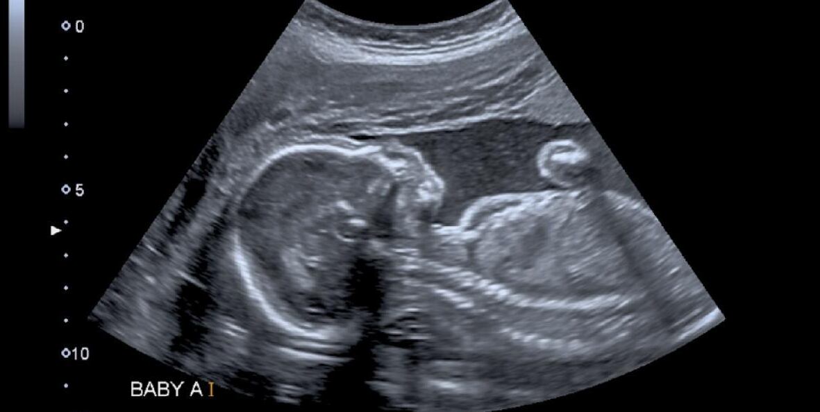 Ultrasonido. Foto: El Tiempo, GDA