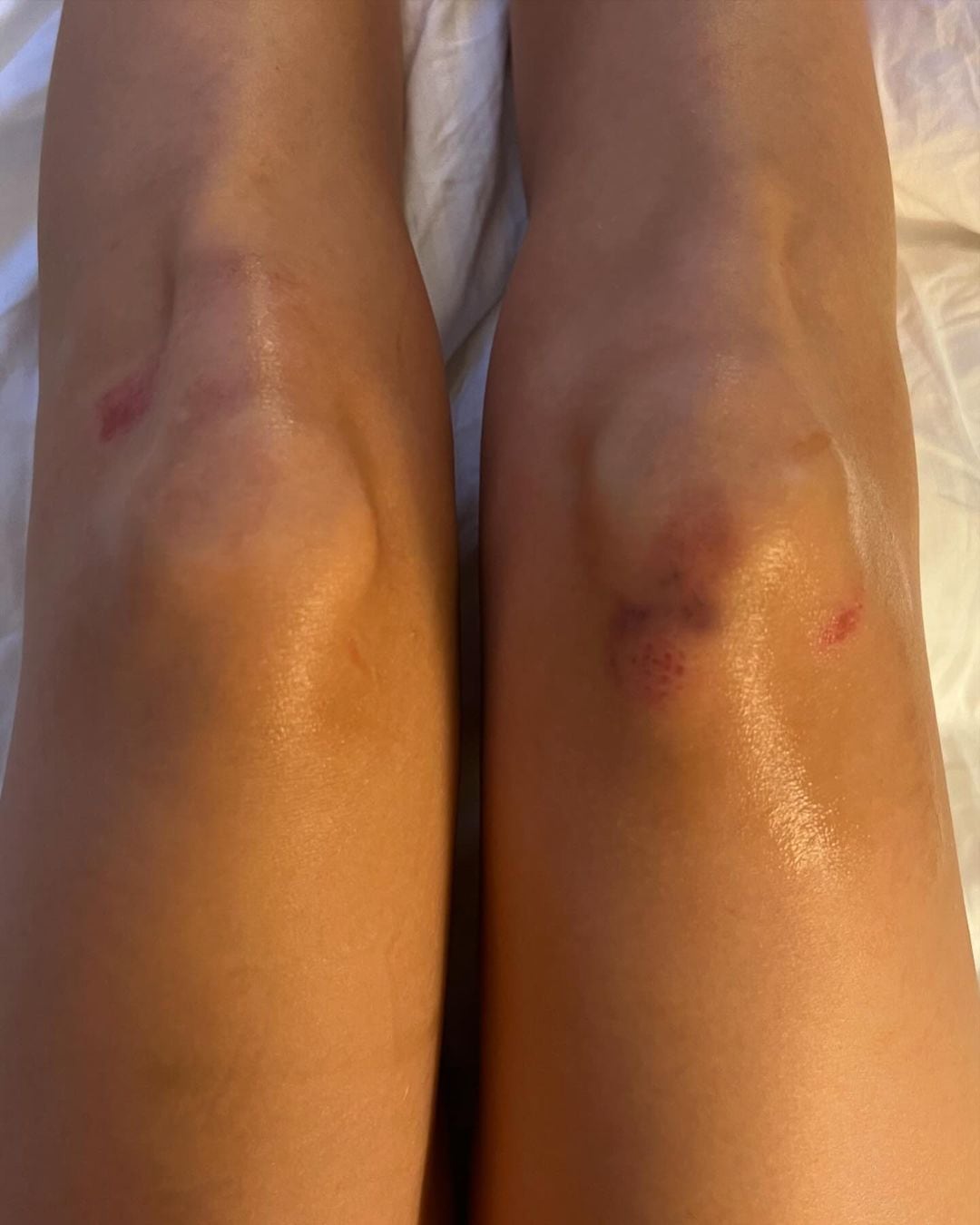 Belinda mostró cómo quedaron sus rodillas luego de su caída en pasarela de París.