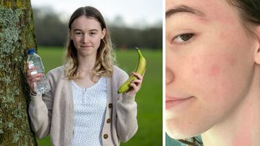 Mujer alérgica al agua cuenta su dolorosa experiencia cuando llueve: “Quiero arrancarme la piel”