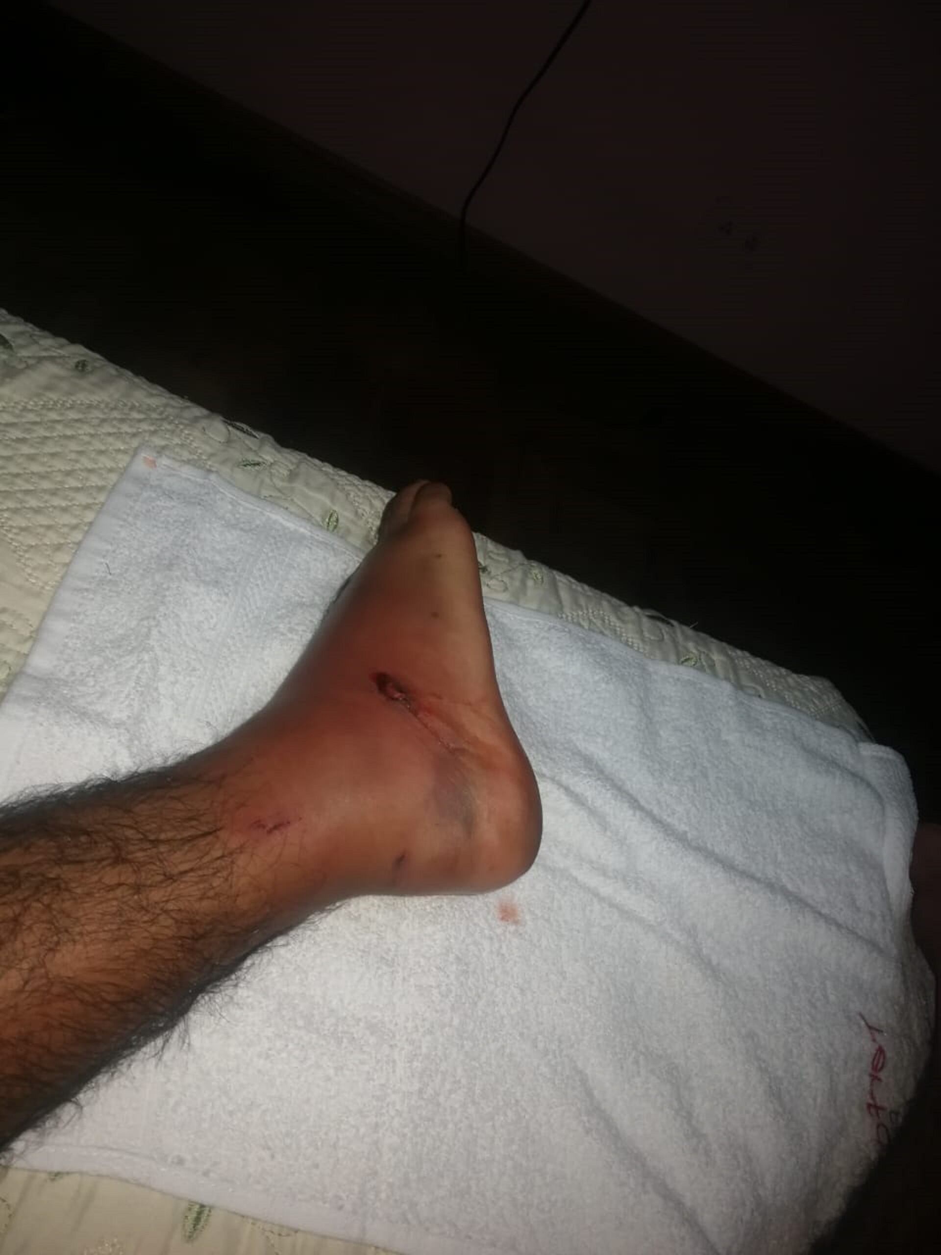 Alexánder Loría: “Por un simple raspón me entró una bacteria y casi me tienen que amputar un pie”