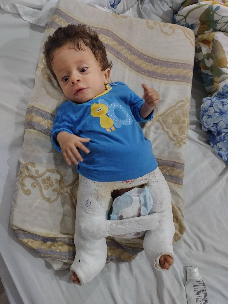 Gael Ramírez Tuly es un hermoso niño de 5 años quien nació con una rara enfermedad y por eso sus huesos no resisten mucho y se quiebran muy seguido