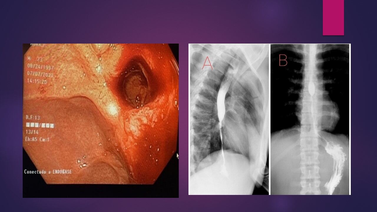 En una cirugía que duró más de 12 horas, especialistas del hospital San Juan de Dios le cambiaron el esófago a un paciente de 23 años, debido a un problema de salud que se lo tenía muy afectado