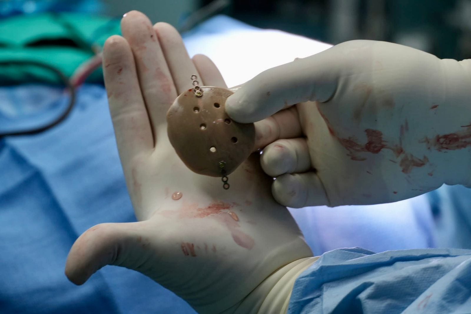 Por primera vez en la historia del país, la Caja Costarricense de Seguro Social (CCSS) le implantó a un paciente una prótesis craneal personalizada, la cual fue diseñada y fabricada por la misma institución usando tecnología de impresión 3D.