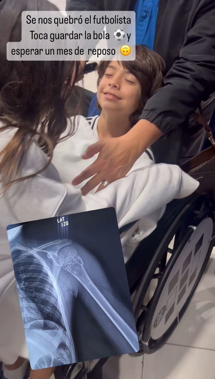 En la radiografía se aprecia la lesión del pequeño Marcelo.