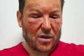Eric Rojas mostró cómo luce ahora su rostro después del procedimiento que lo dejó irreconocible