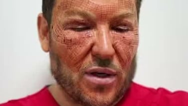 Doctor Eric Rojas revela los apodos que recibió tras procedimiento estético que cambió su rostro