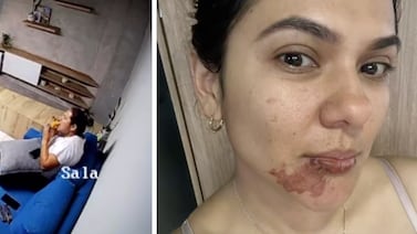 Empanada le explota en la cara a mujer y le provoca graves quemaduras
