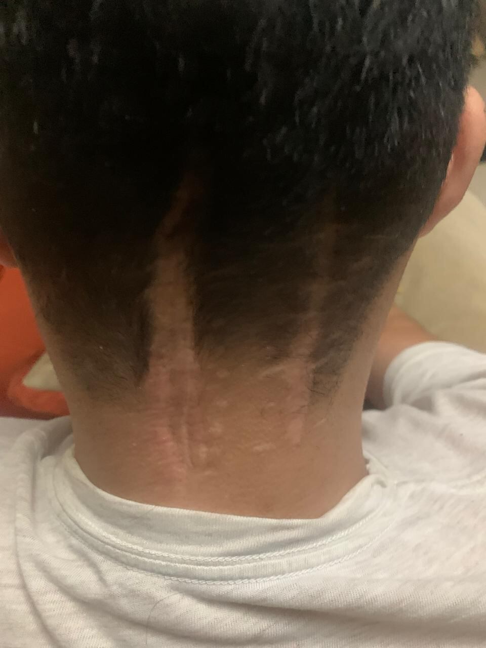 Norman Aguilar Castro en un joven de 29 años padece el padece el síndrome Von hippel lindau