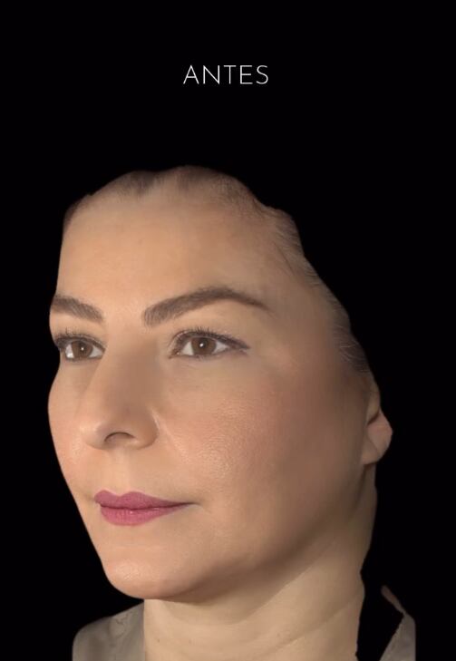 Glenda Peraza se hizo una FaceTite