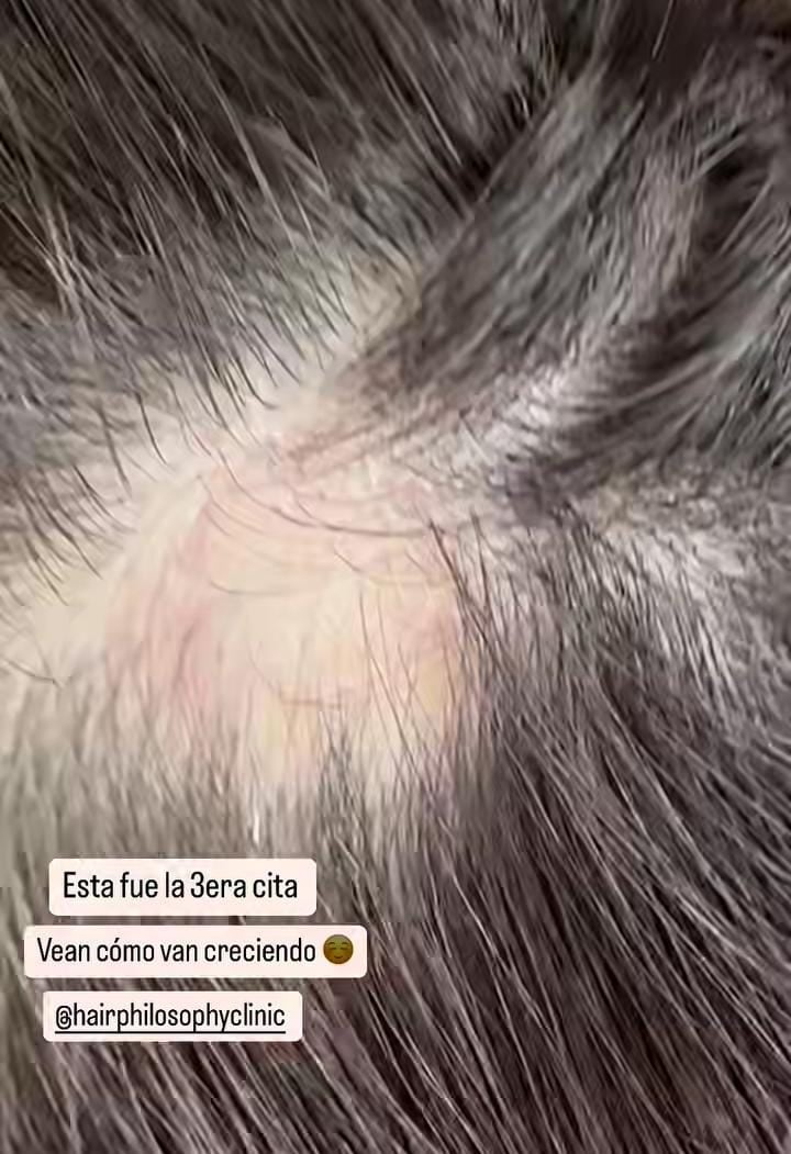 Nicole Aldana mostró gran perdida de cabello