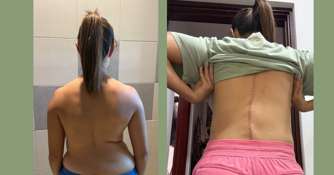 Ginés Rodríguez con su antes y después de la operación de columna.