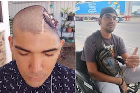 Joven perdió parte de su cráneo en accidente y su mamá celebra cada palabra que dice como un milagro