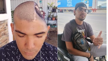 Joven perdió parte de su cráneo en accidente y su mamá celebra cada palabra que dice como un milagro