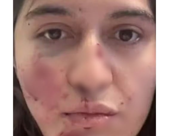 Marcela Montalva sufrió múltiples fracturas tras el ataque de una urraca en Ravenswood, Australia.