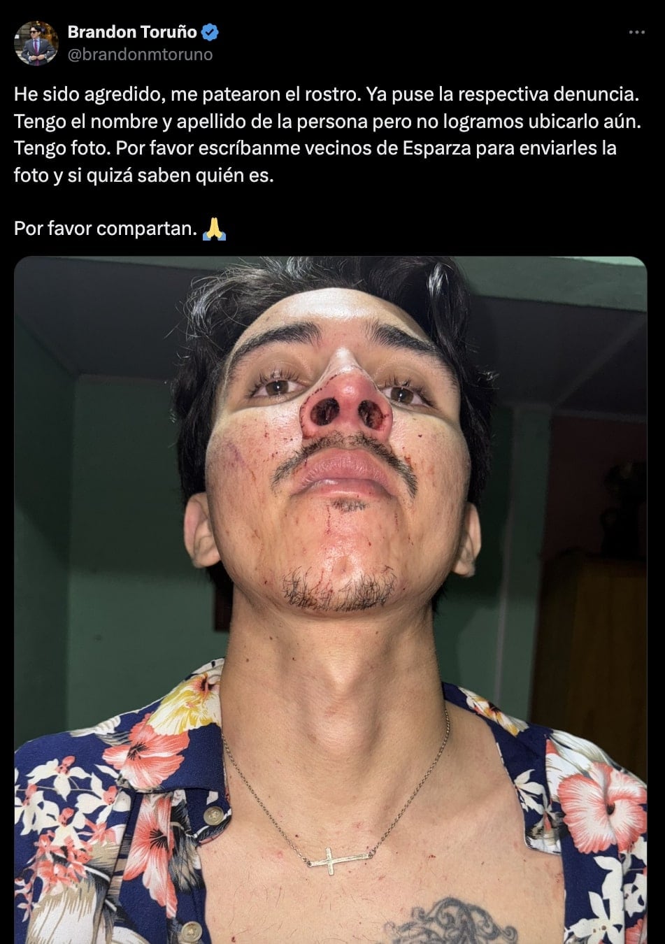 Así quedó Brandon Toruño tras el ataque físico que sufrió este fin de semana. Foto: Captura.