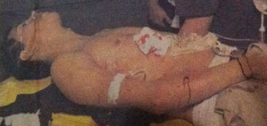 Herson Torres Cabezas sobreviviente de tres balazos para robarle un celular