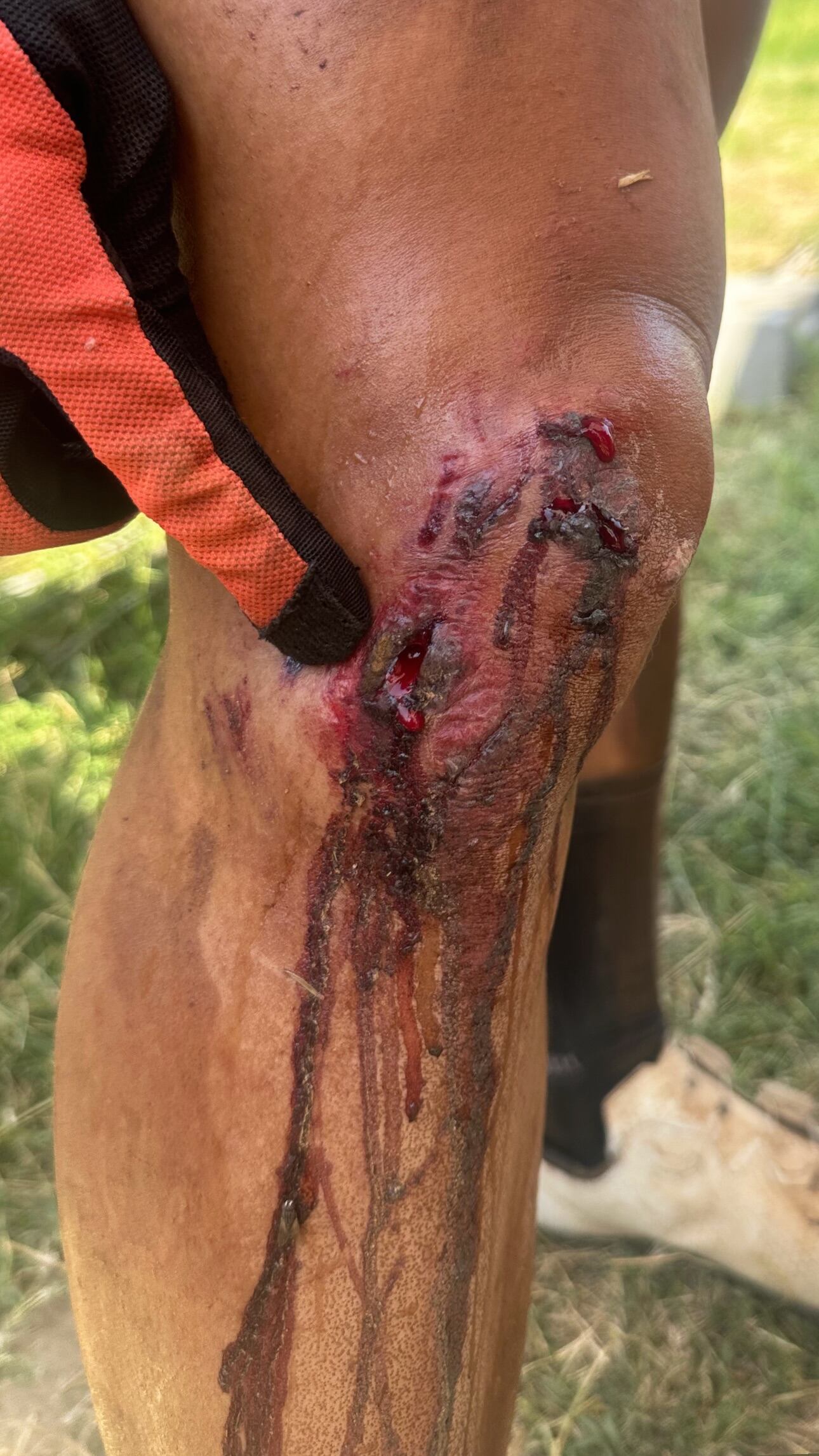 Johanna Solano sufrió un accidente en Sudáfrica este miércoles mientras disputaba la tercera etapa de la The Untamed African MTB Race, una de las competencias de ciclismo de montaña más famosas del mundo.