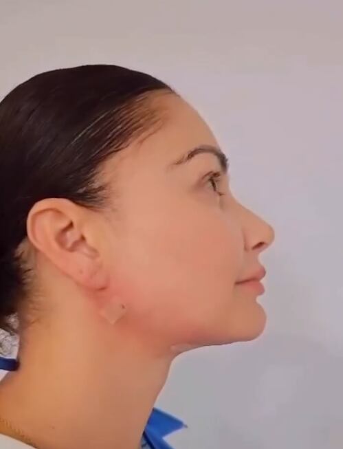 Marilin Gamboa se sometió a un nuevo arreglito estético para atacar uno de los complejos que tiene en su rostro y que la han atormentado por mucho tiempo.