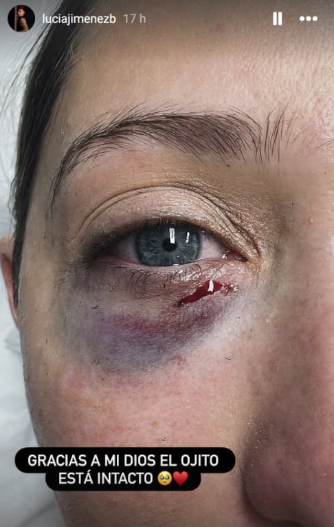 Lucía Jiménez, bailarina de Mira quién baila (MQB) y su golpe en el ojo.