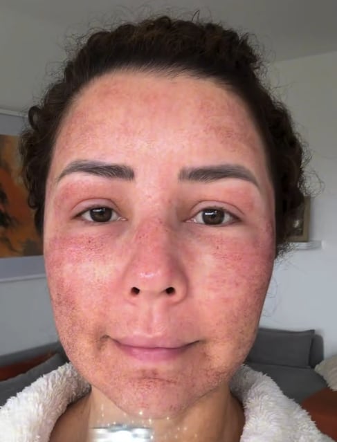 Nadia Aldana se quiso quitar unos años de encima y para lograrlo se sometió a un tratamiento que le impactará.