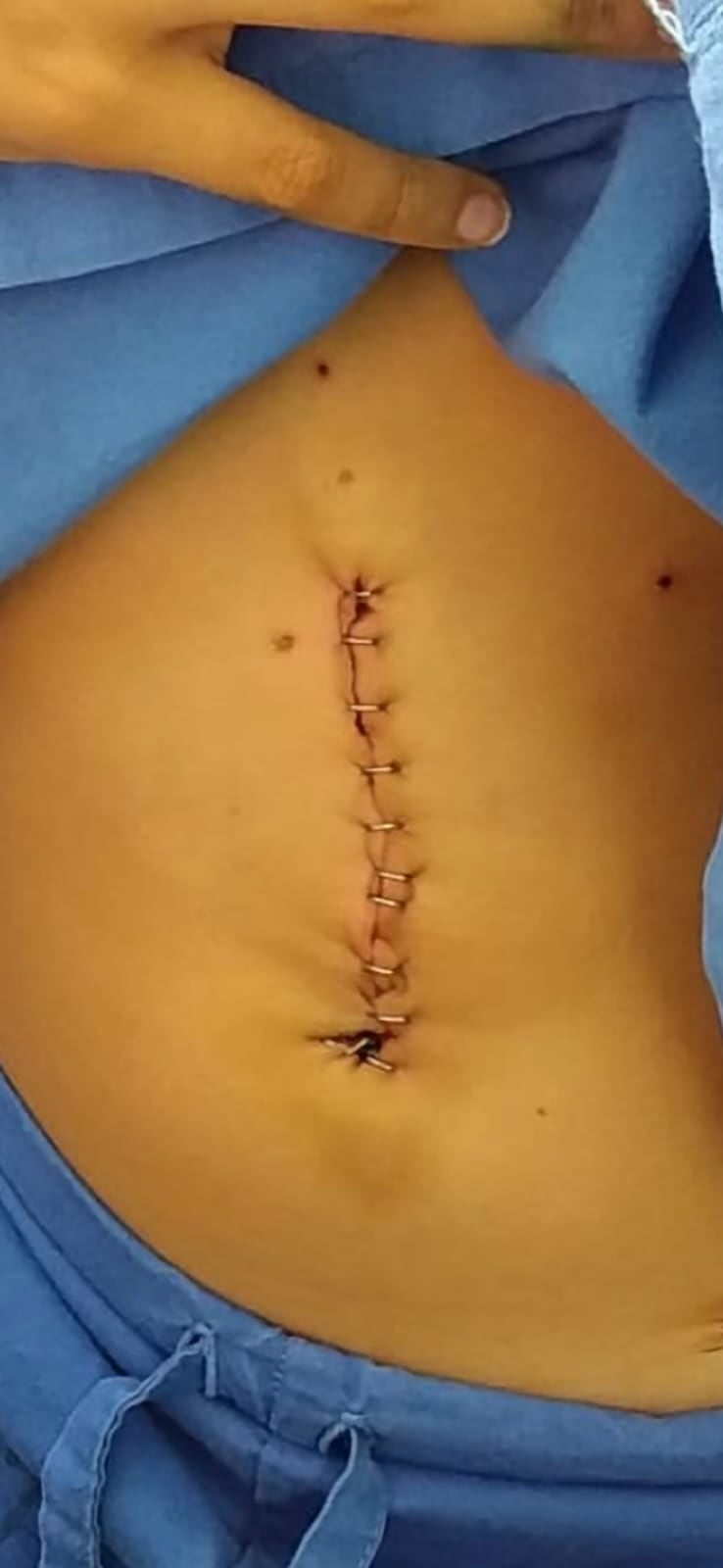 Mahischa Hernández pasó de vivir entre hospitales y cirugías a convertirse en una de las jóvenes promesas de los barriles en Costa Rica junto a su yegua Mariposa