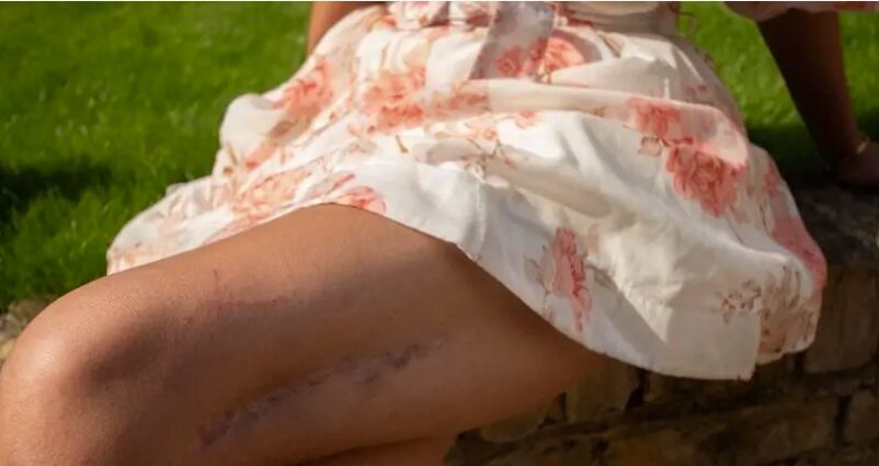 Elaine Foo se operó las piernas