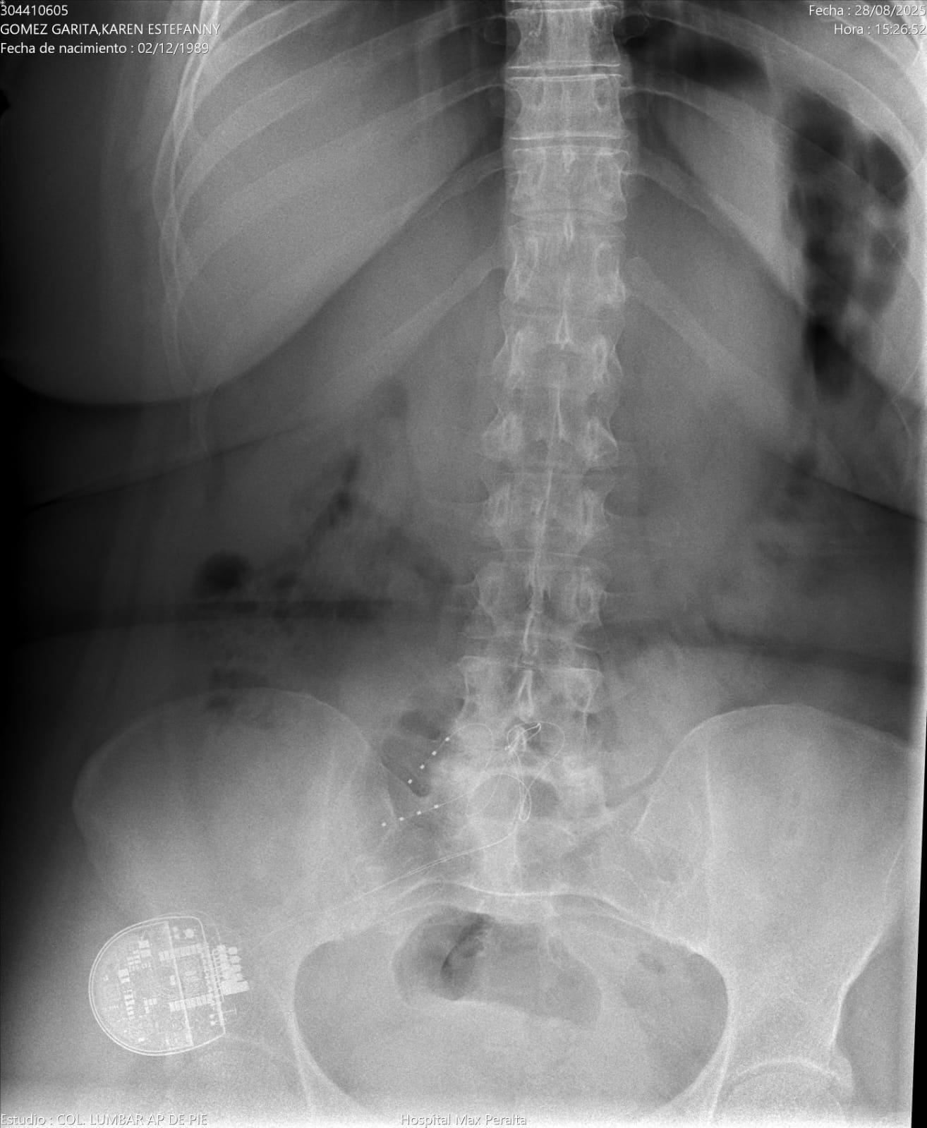 Karen nos comparte la radiografía que muestra el neuro estimulador que posee para poder lidiar con sus padecimientos.