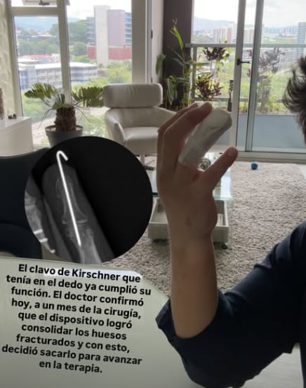 Jason Ureña, periodista de Telenoticias sigue en recuperación tras su accidente de tránsito.