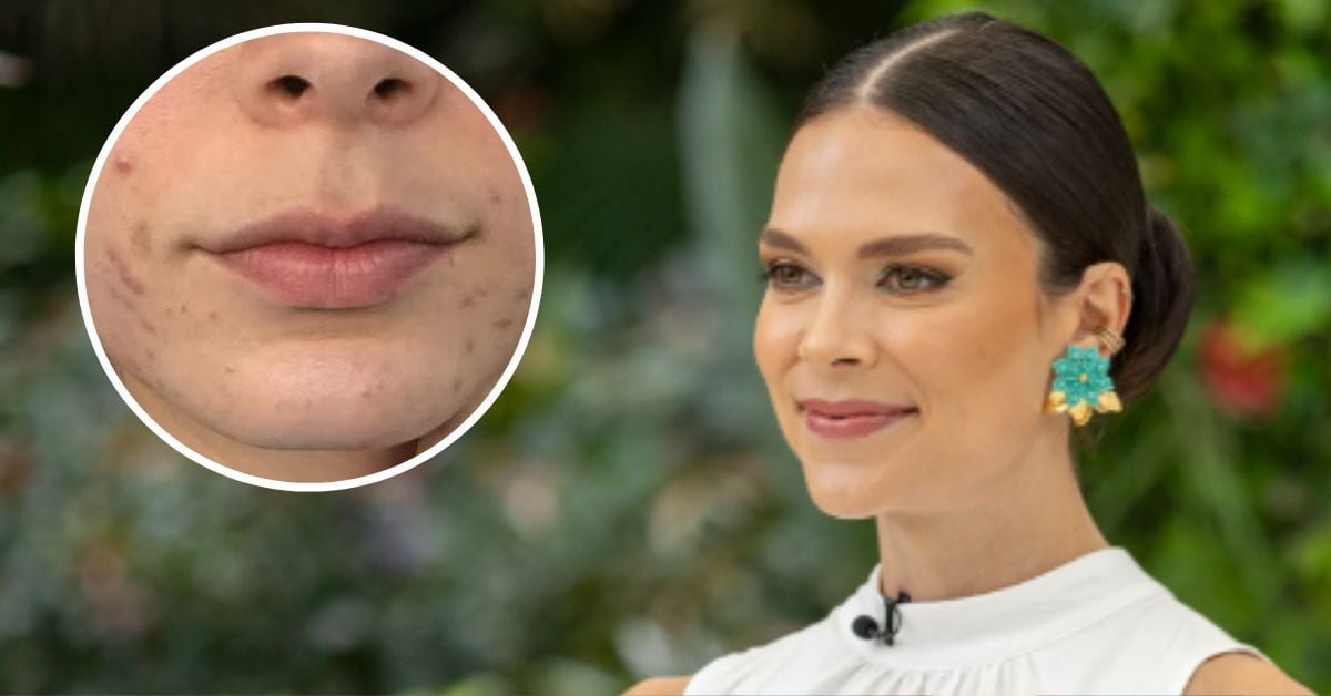 Una mujer sonríente y un círculo en el que se ve la parte inferior de un rostro femenino con brotes de acné