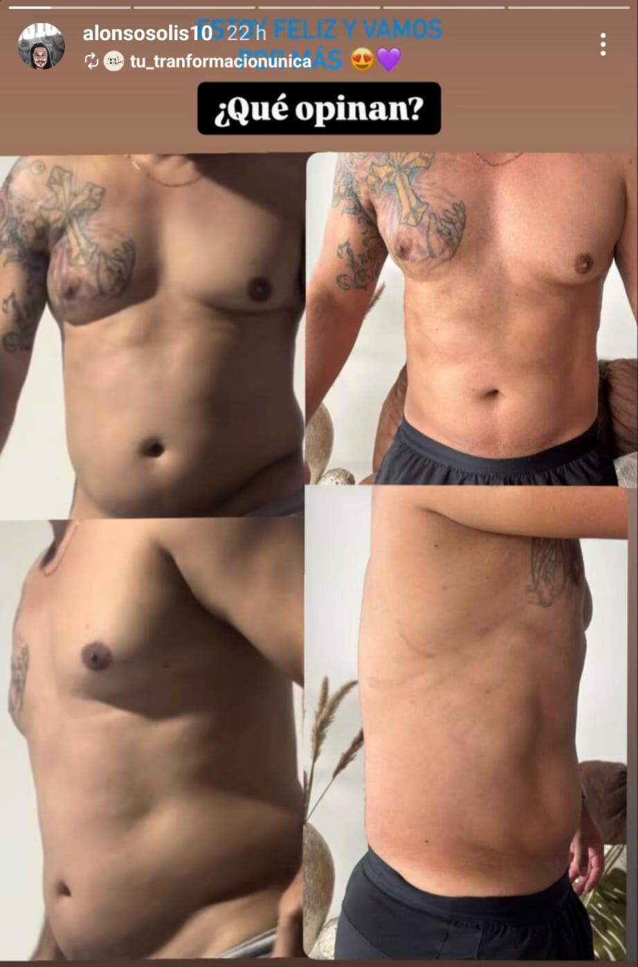 Alonso Solís muestra los resultados de un tratamiento al que se está sometiendo. Instagram Alonso Solís.