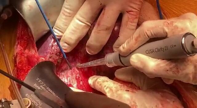 Especialistas del Hospital San Juan de Dios le quitaron un tumor bien grande a un joven, el cual se encontraba ubicado en el lado derecho del tórax y ponía en peligro órganos vitales como corazón, riñón, hígado y la vena cava inferior