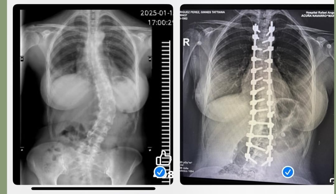 Ginés Rodríguez con su antes y después de la operación de columna.