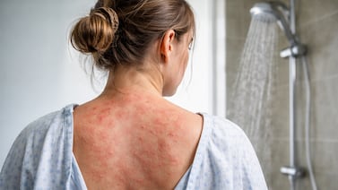 Joven vive pesadilla al ser alérgica al agua: hasta sus propias lágrimas le causan dolor insoportable