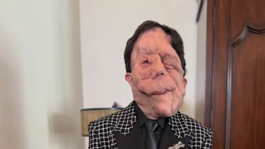 Premios Óscar 2026: ¿Quién es Adam Pearson y qué enfermedad padece?