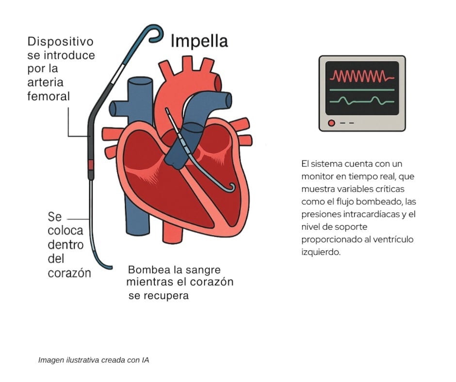 Impella, una tecnología que permite que el corazón siga recibiendo sangre aunque deje de latir por momentos.