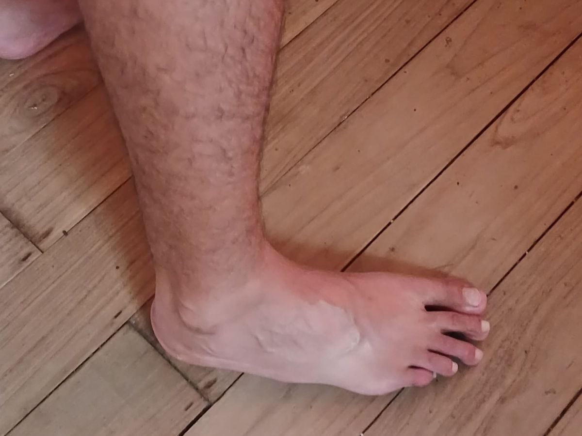 Si bien no se nota, el dolor de Andrey en su pierna es indescriptible.