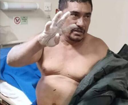 Alejandro Pérez Gutiérrez estuvo 57 horas nadando en altamar, sus manos son una muestra de cómo el agua con sal se las dejó. Foto: Cortesía para La Teja