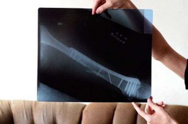 Kenneth Delgado Fernández recibió 11 balazos y vivió para contarla. En la foto se aprecia la cantidad de pines para reconstruirle el femur.