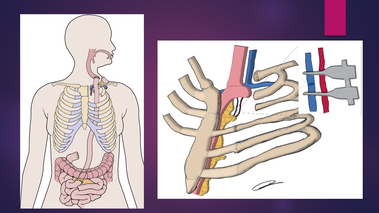 En una cirugía que duró más de 12 horas, especialistas del hospital San Juan de Dios le cambiaron el esófago a un paciente de 23 años, debido a un problema de salud que se lo tenía muy afectado