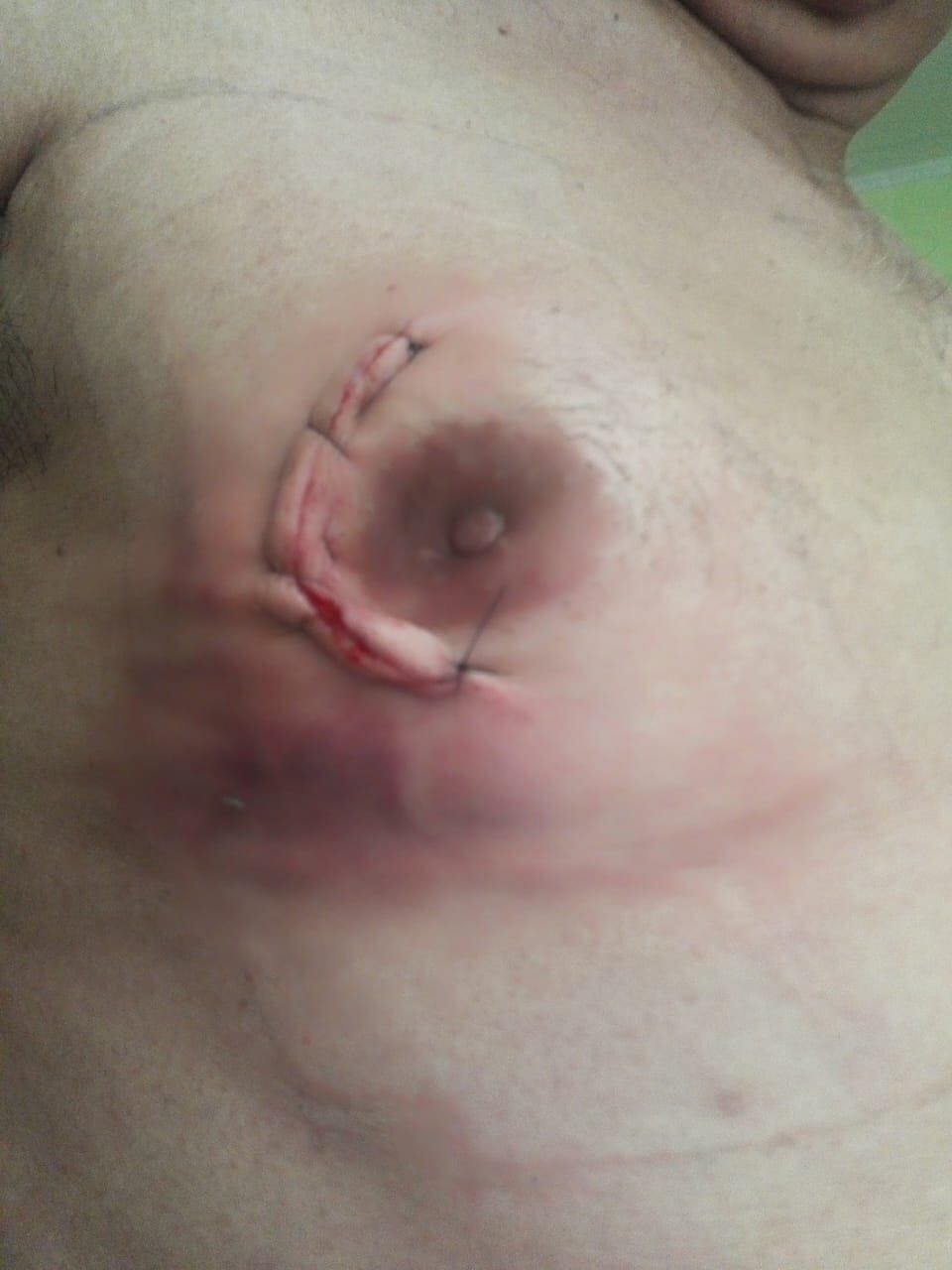 Don Norman Arturo Burke Alfaro, de 57 años, siempre se informó bien y por eso el cáncer de mama no lo tomó por sorpresa, ante los primeros síntomas se hacía a diario el autoexamen de mamas y semanas después su presentimiento se confirmó: tenía cáncer