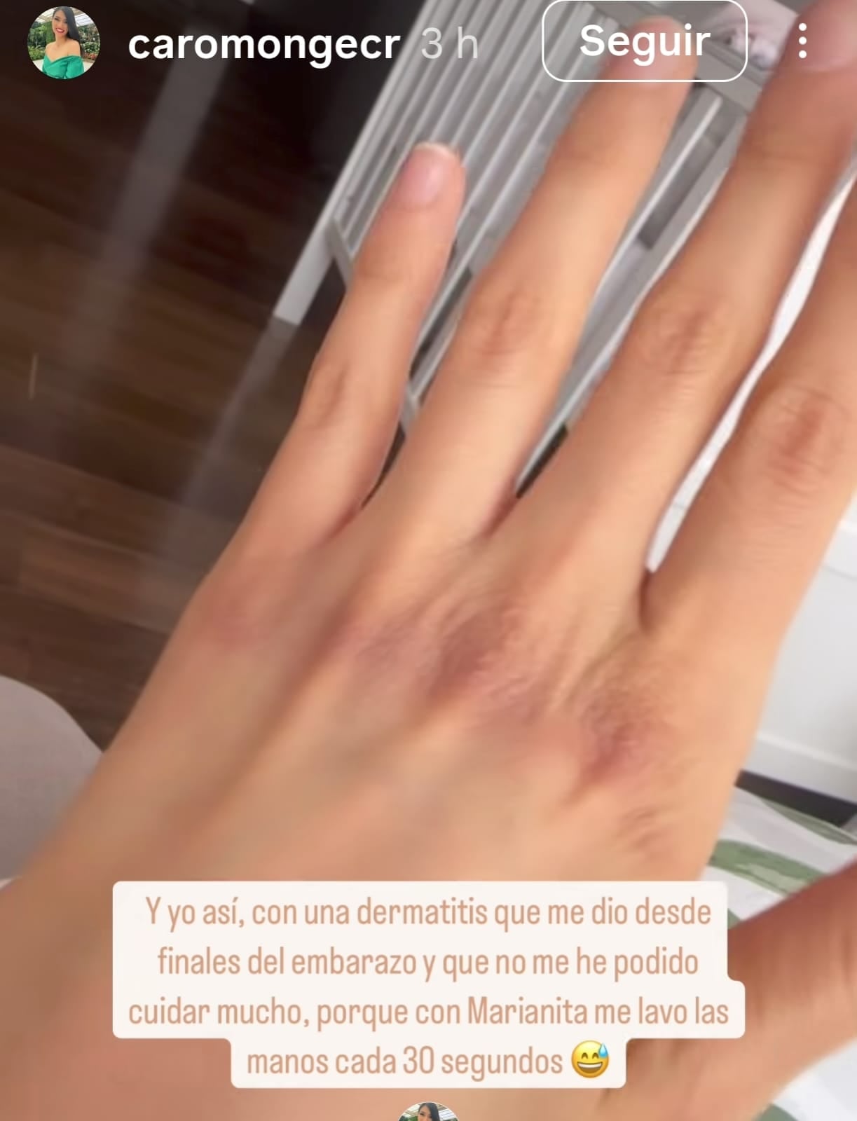 Estas son las marcas de la dermatitis que padece Carollina Monge, periodista de 'Buen día' de Teletica, desde antes de que naciera su bebé.